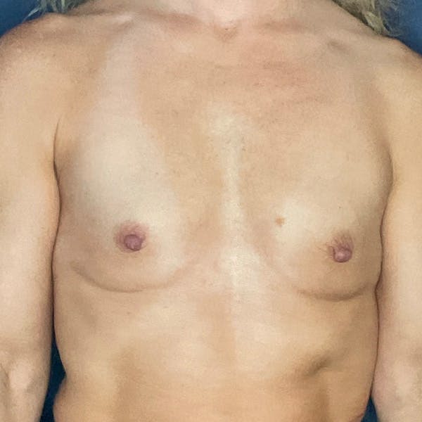Breast Augmentation Before & After Gallery - Patient 250518 - Image 1