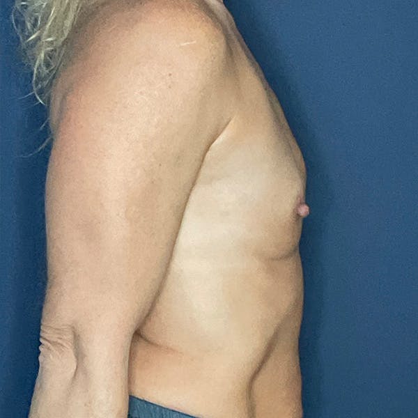 Breast Augmentation Before & After Gallery - Patient 250518 - Image 3