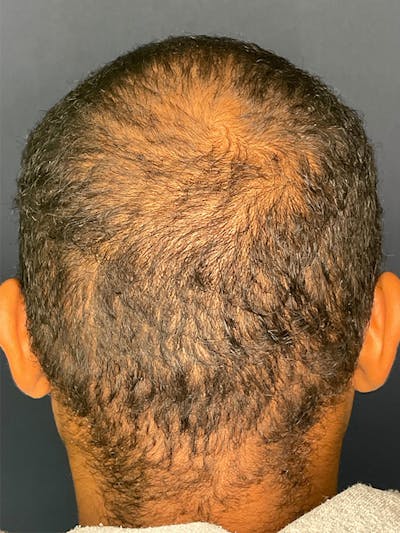 PRF/Platinum PRP 2.0 for Hair Restoration Before & After Gallery - Patient 350226 - Image 1