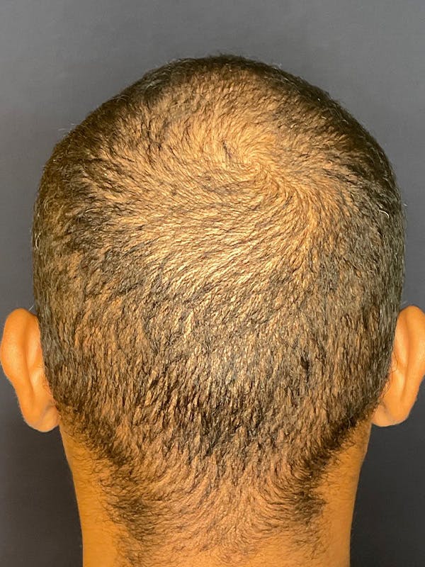 PRF/Platinum PRP 2.0 for Hair Restoration Before & After Gallery - Patient 350226 - Image 2