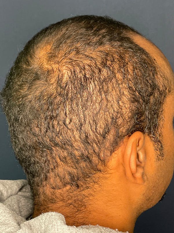 PRF/Platinum PRP 2.0 for Hair Restoration Before & After Gallery - Patient 350226 - Image 3