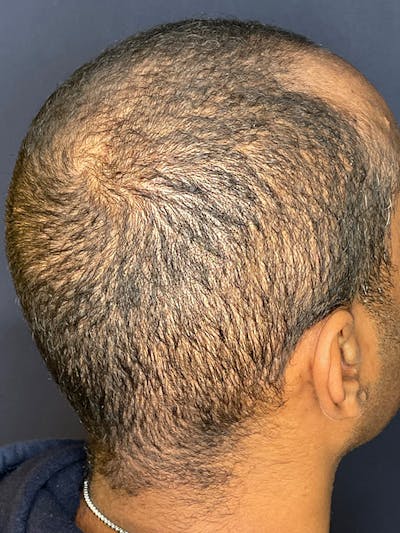 PRF/Platinum PRP 2.0 for Hair Restoration Before & After Gallery - Patient 350226 - Image 4