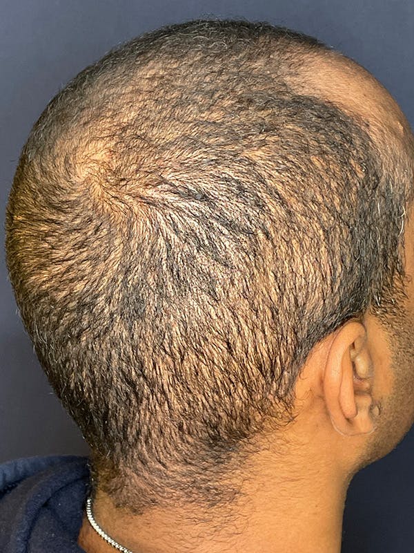 PRF/Platinum PRP 2.0 for Hair Restoration Before & After Gallery - Patient 350226 - Image 4