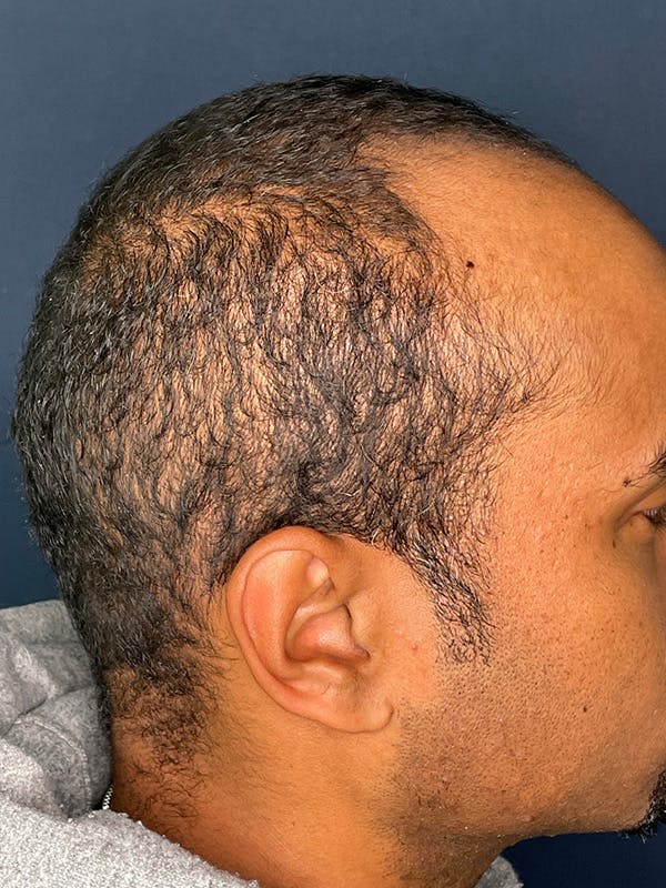 PRF/Platinum PRP 2.0 for Hair Restoration Before & After Gallery - Patient 350226 - Image 5
