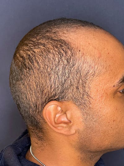 PRF/Platinum PRP 2.0 for Hair Restoration Before & After Gallery - Patient 350226 - Image 6