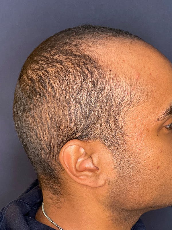 PRF/Platinum PRP 2.0 for Hair Restoration Before & After Gallery - Patient 350226 - Image 6