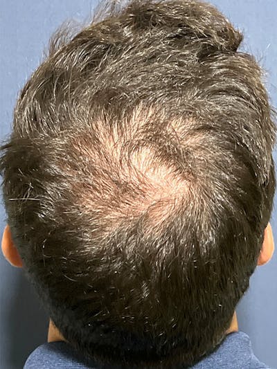 PRF/Platinum PRP 2.0 for Hair Restoration Before & After Gallery - Patient 295880 - Image 1
