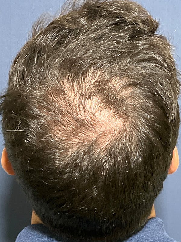 PRF/Platinum PRP 2.0 for Hair Restoration Before & After Gallery - Patient 295880 - Image 1