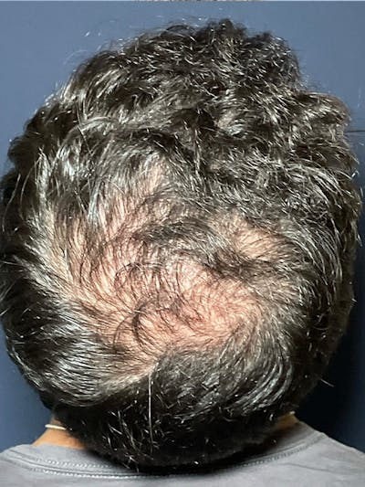 PRF/Platinum PRP 2.0 for Hair Restoration Before & After Gallery - Patient 295880 - Image 2