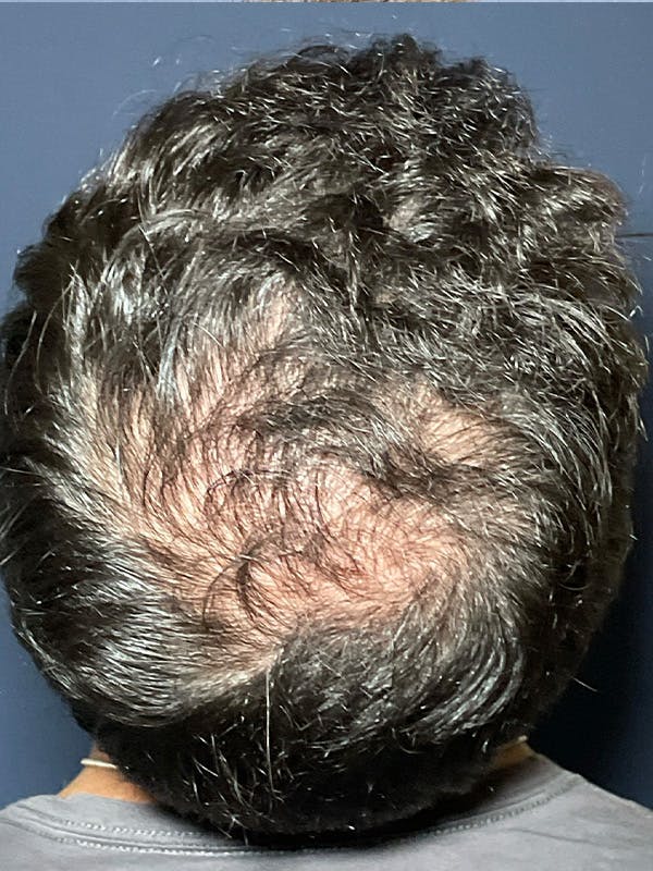 PRF/Platinum PRP 2.0 for Hair Restoration Before & After Gallery - Patient 295880 - Image 2