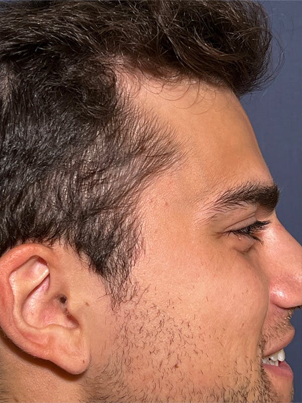 PRF/Platinum PRP 2.0 for Hair Restoration Before & After Gallery - Patient 295880 - Image 3