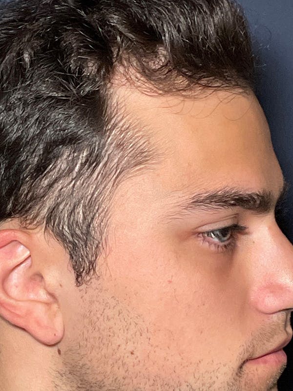 PRF/Platinum PRP 2.0 for Hair Restoration Before & After Gallery - Patient 295880 - Image 4