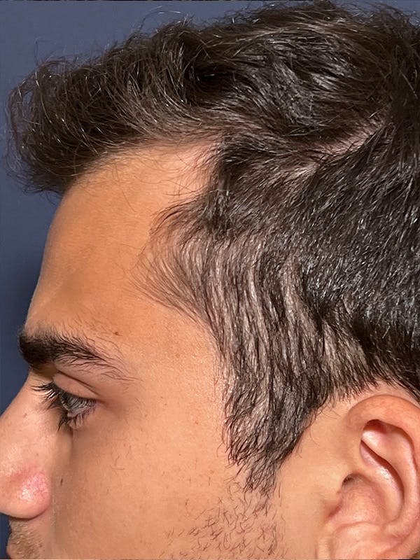 PRF/Platinum PRP 2.0 for Hair Restoration Before & After Gallery - Patient 295880 - Image 5