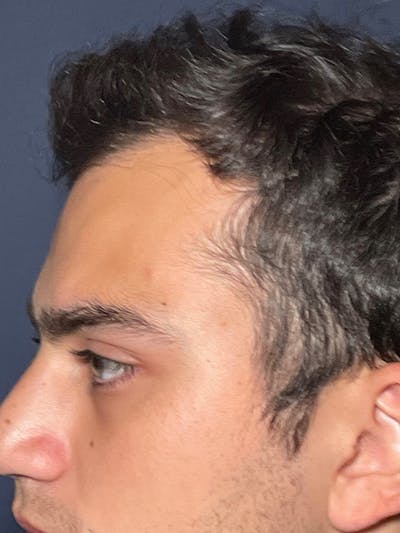 PRF/Platinum PRP 2.0 for Hair Restoration Before & After Gallery - Patient 295880 - Image 6