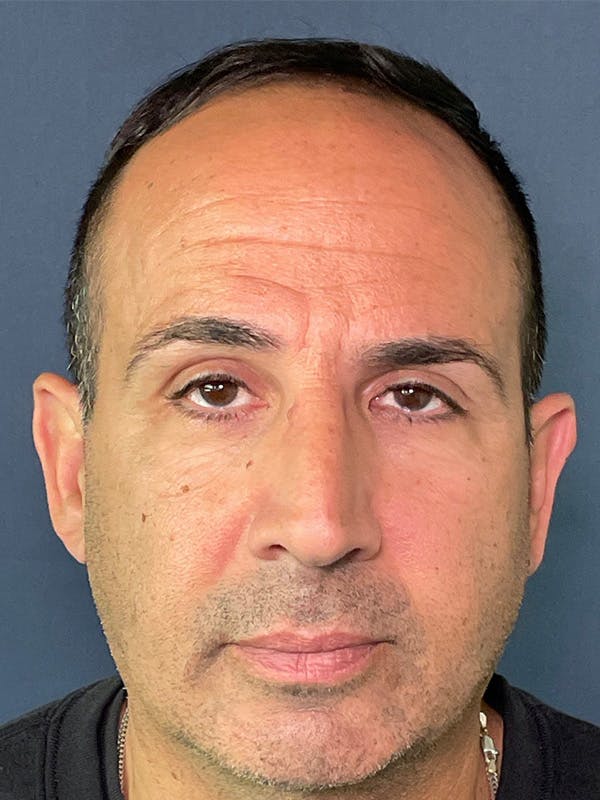 PRF/Platinum PRP 2.0 for Hair Restoration Before & After Gallery - Patient 121158 - Image 1