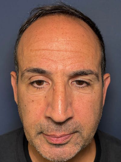 PRF/Platinum PRP 2.0 for Hair Restoration Before & After Gallery - Patient 121158 - Image 2