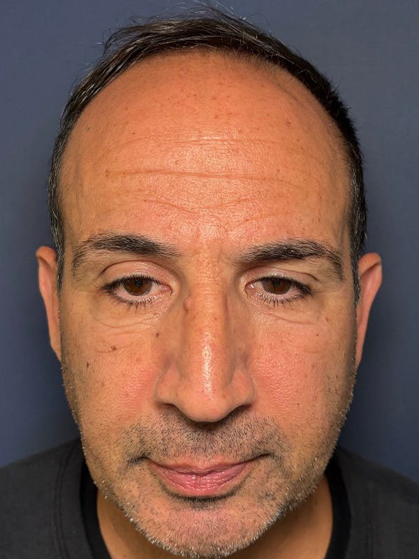 PRF/Platinum PRP 2.0 for Hair Restoration Before & After Gallery - Patient 121158 - Image 2