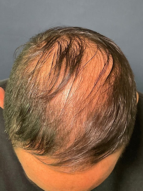 PRF/Platinum PRP 2.0 for Hair Restoration Before & After Gallery - Patient 121158 - Image 3