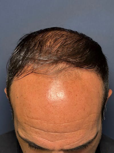 PRF/Platinum PRP 2.0 for Hair Restoration Before & After Gallery - Patient 121158 - Image 4