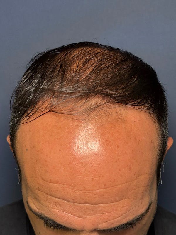 PRF/Platinum PRP 2.0 for Hair Restoration Before & After Gallery - Patient 121158 - Image 4