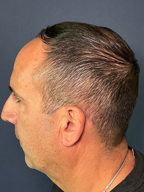PRF/Platinum PRP 2.0 for Hair Restoration Before & After Gallery - Patient 121158 - Image 5