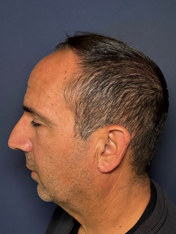 PRF/Platinum PRP 2.0 for Hair Restoration Before & After Gallery - Patient 121158 - Image 6