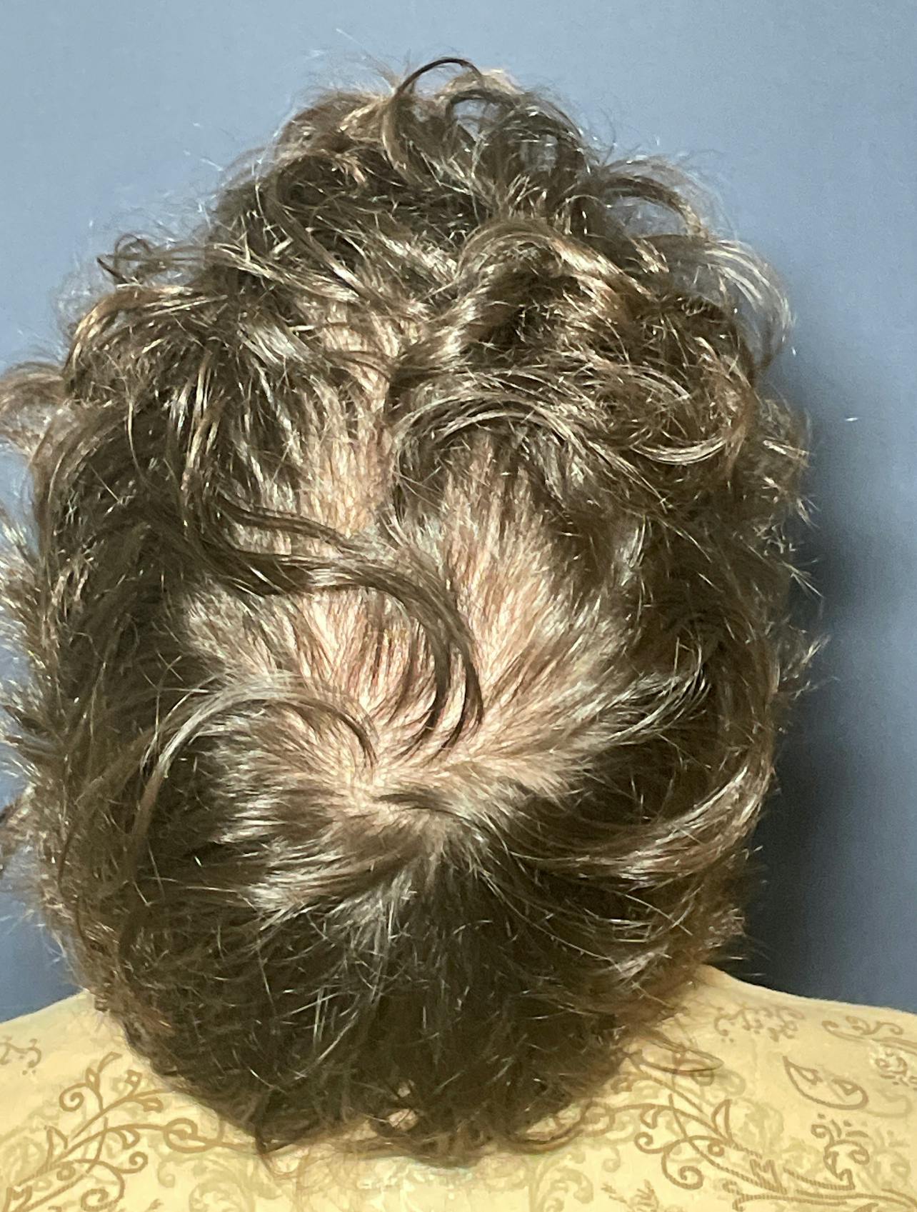 PRF/Platinum PRP 2.0 for Hair Restoration Before & After Gallery - Patient 317227 - Image 1