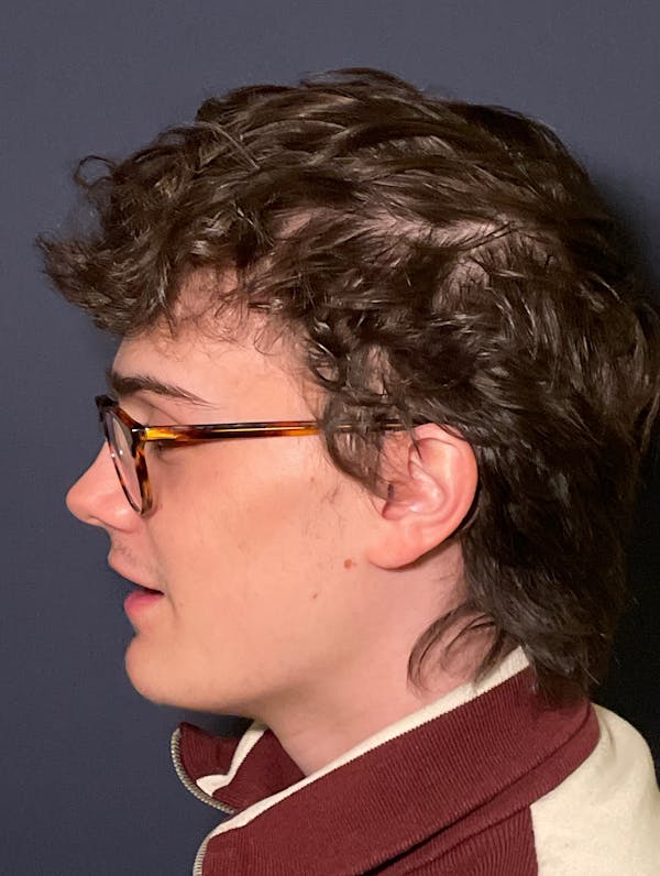 PRF/Platinum PRP 2.0 for Hair Restoration Before & After Gallery - Patient 317227 - Image 5