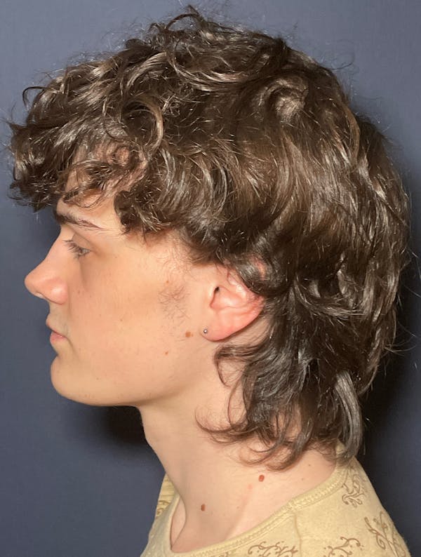 PRF/Platinum PRP 2.0 for Hair Restoration Before & After Gallery - Patient 317227 - Image 6