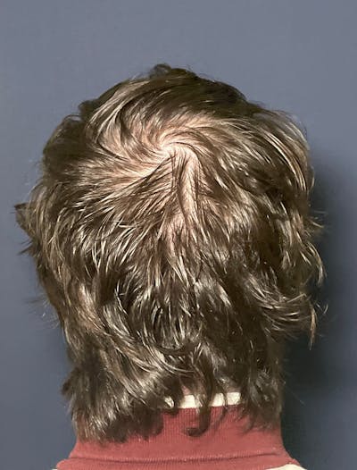 PRF/Platinum PRP 2.0 for Hair Restoration Before & After Gallery - Patient 317227 - Image 4