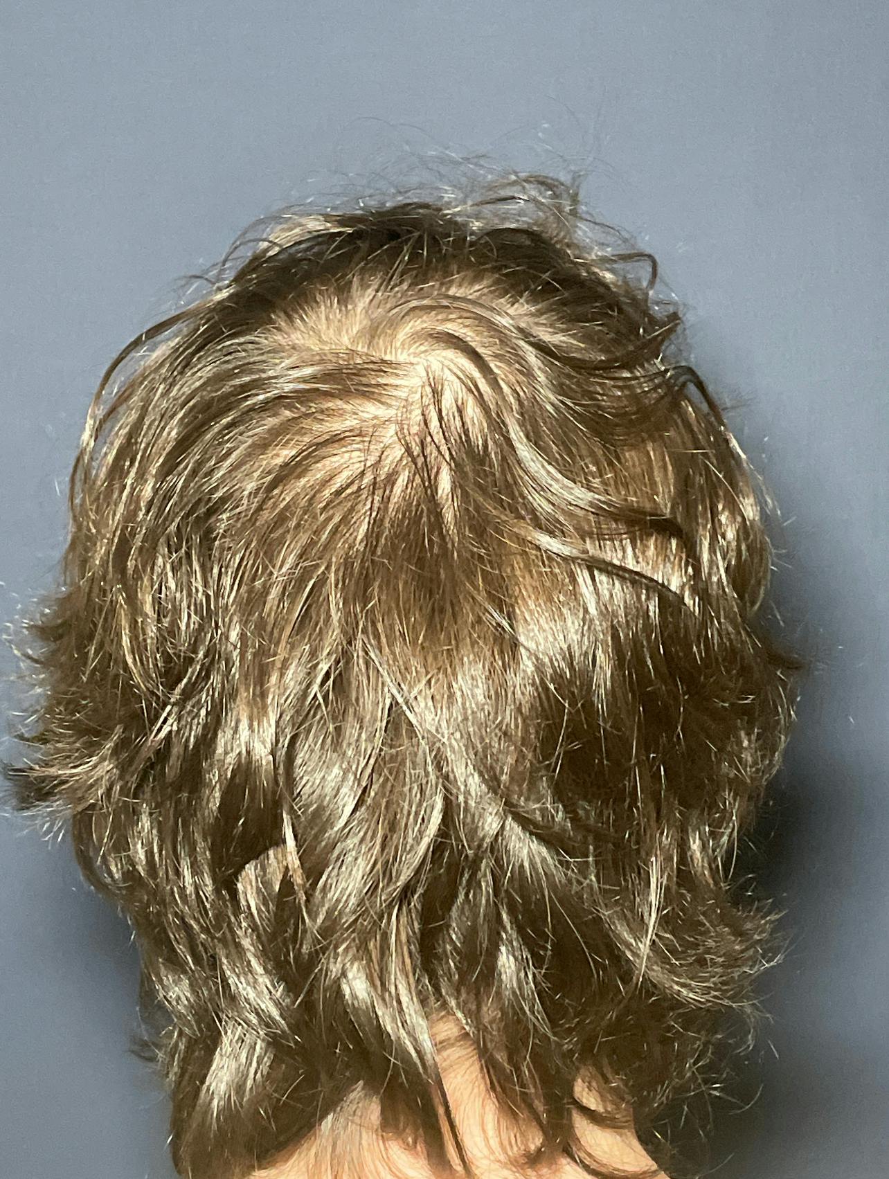 PRF/Platinum PRP 2.0 for Hair Restoration Before & After Gallery - Patient 317227 - Image 2