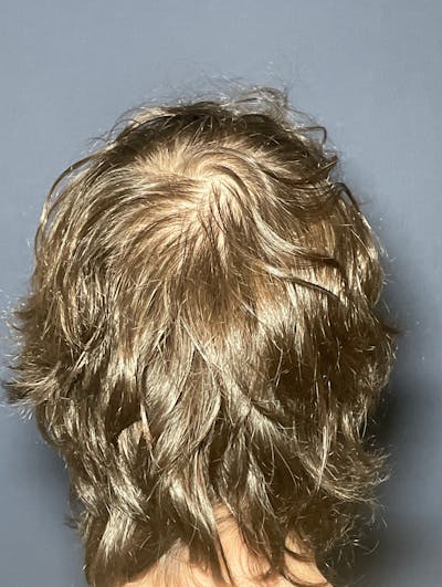 PRF/Platinum PRP 2.0 for Hair Restoration Before & After Gallery - Patient 317227 - Image 2