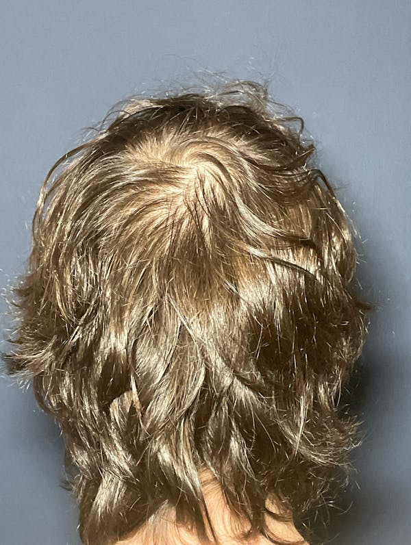 PRF/Platinum PRP 2.0 for Hair Restoration Before & After Gallery - Patient 317227 - Image 2