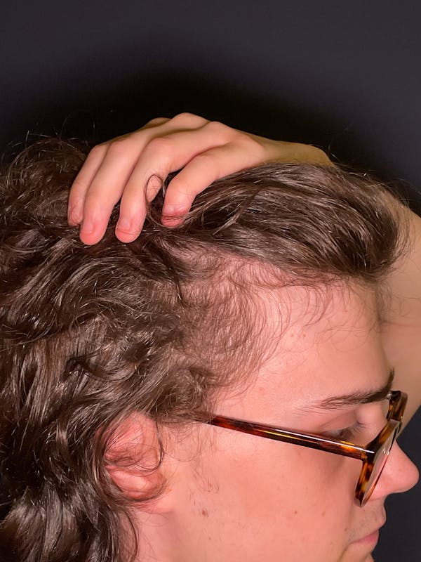 PRF/Platinum PRP 2.0 for Hair Restoration Before & After Gallery - Patient 317227 - Image 8