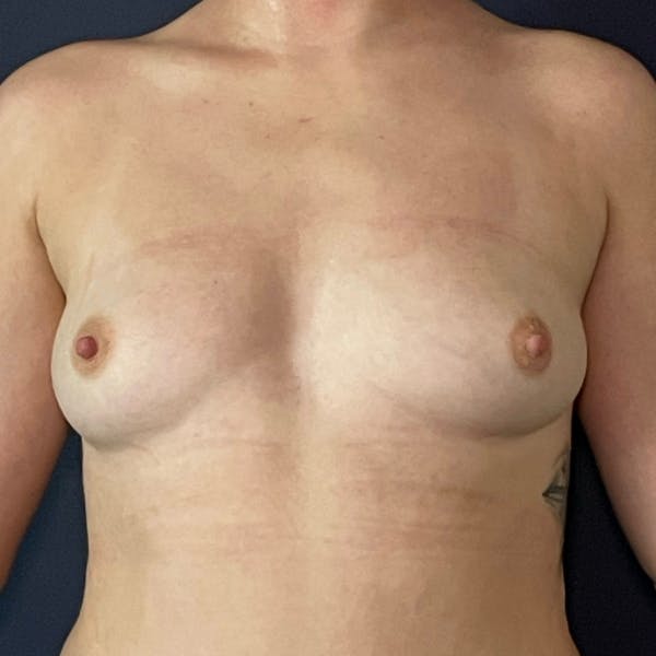 Breast Augmentation Before & After Gallery - Patient 109947 - Image 1
