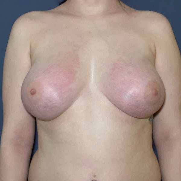 Breast Augmentation Before & After Gallery - Patient 109947 - Image 2