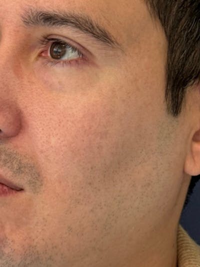 Sculptra™ Before & After Gallery - Patient 460964 - Image 2