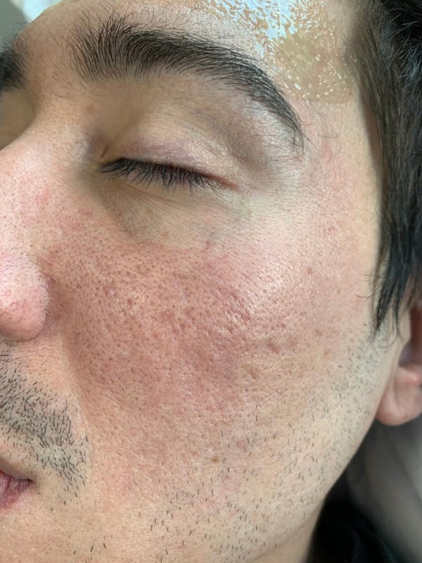 Sculptra™ Before & After Gallery - Patient 460964 - Image 1