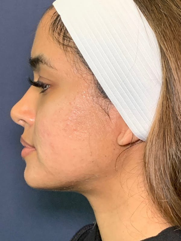 Sculptra™ Before & After Gallery - Patient 352621 - Image 2