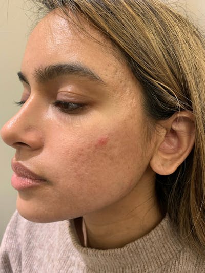 Sculptra™ Before & After Gallery - Patient 352621 - Image 1