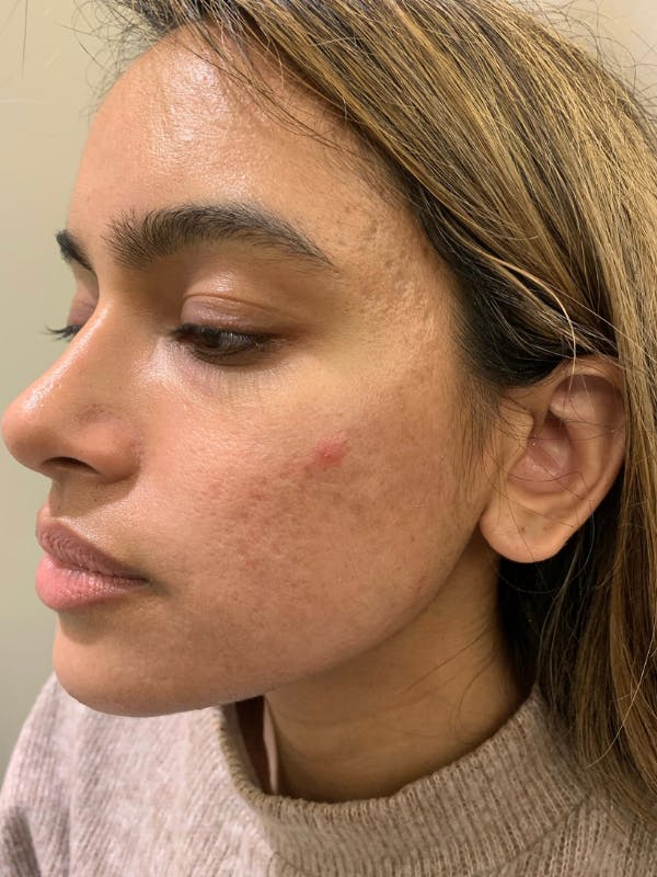 Sculptra™ Before & After Gallery - Patient 352621 - Image 1