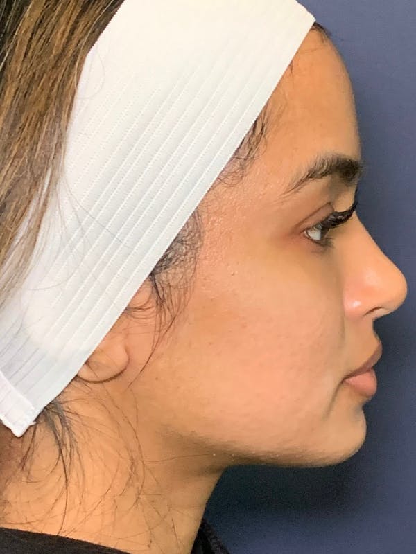 Sculptra™ Before & After Gallery - Patient 352621 - Image 4