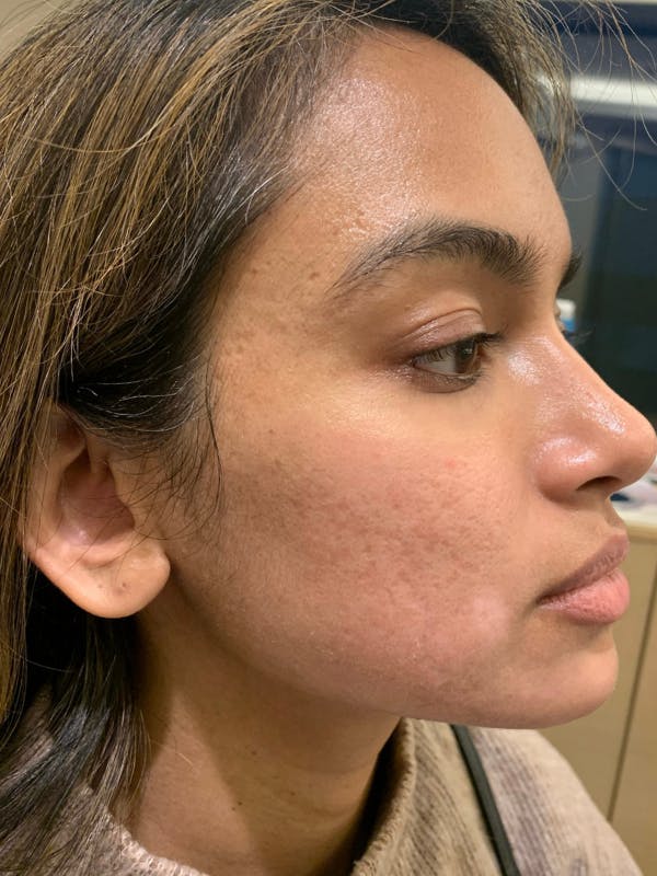 Sculptra™ Before & After Gallery - Patient 352621 - Image 3