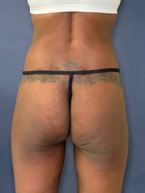 Alloclae Before & After Gallery - Patient 331513 - Image 2