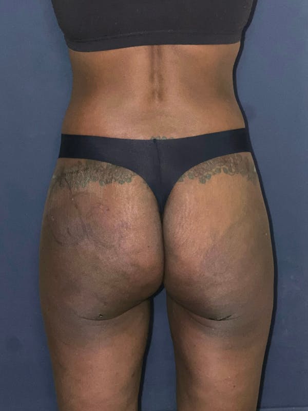 Alloclae Before & After Gallery - Patient 331513 - Image 1