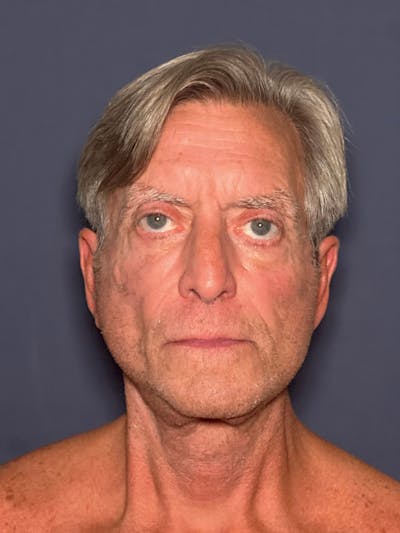 Facelift Before & After Gallery - Patient 418678 - Image 2