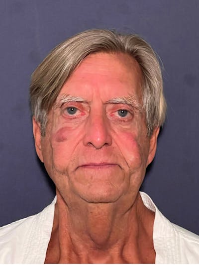 Facelift Before & After Gallery - Patient 418678 - Image 1