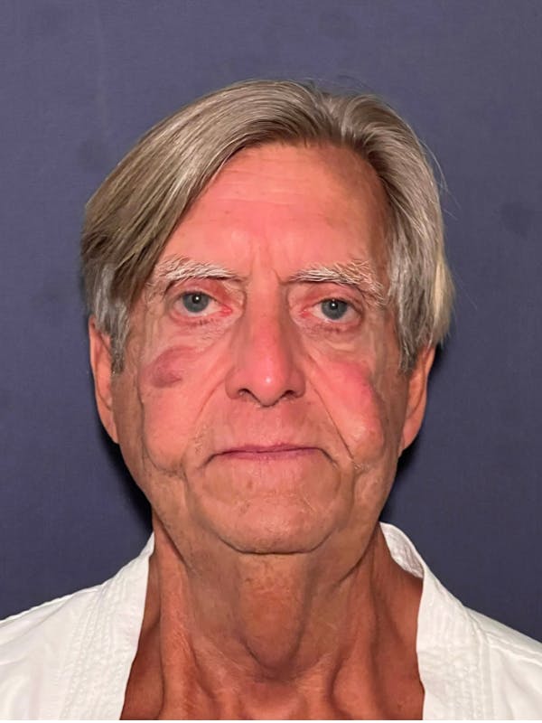 Facelift Before & After Gallery - Patient 418678 - Image 1