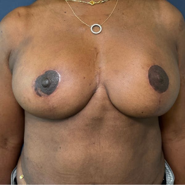 NaturaBra® Mastopexy Before & After Gallery - Patient 180380 - Image 2