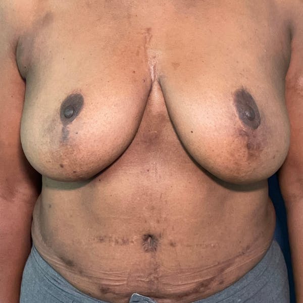 NaturaBra® Mastopexy Before & After Gallery - Patient 180380 - Image 1